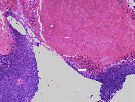 Typical Microscopic Appearance Of Pilomatrixoma Consisting Of