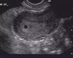 Bebê De 4 Semanas - 4 semanas de gravidez | O Meu Bebé