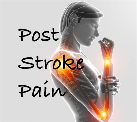 Post Stroke Pain: Diagnosis and Treatment - Rehab HQ