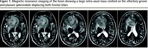 Planum Sphenoidale Meningioma