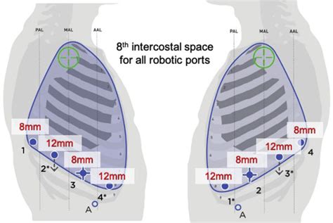 Robotic Assisted Left Lower Lobe Pulmonary Lobectomy Eleven Steps