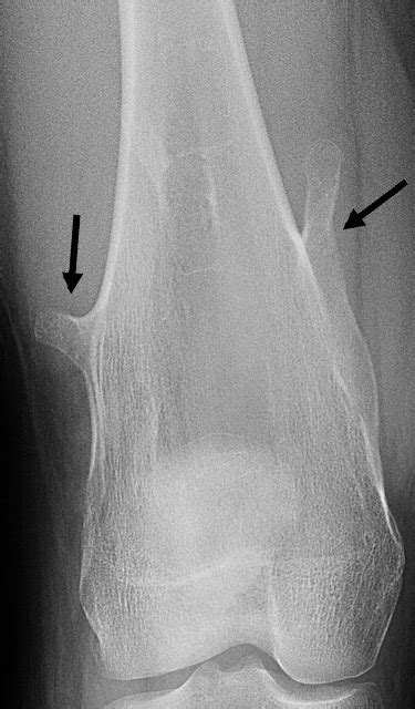 Osteochondroma Causes Symptoms And Treatments Hss