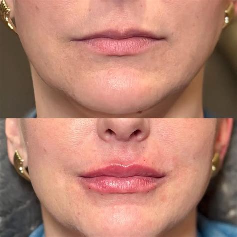 Dermal Fillers In Mason And Cincinnati OH Medimorph