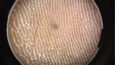 Man's niggling foot pain caused by rare 'hair splinter' | CTV News