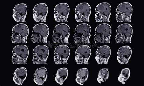 MRI BRAIN Finding of Meningioma Arising from Anterior Falx Cerebri ...