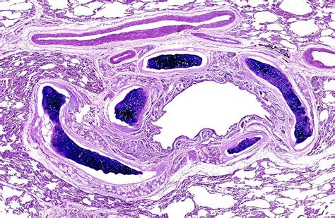 Chronic Bronchitis Photograph By Nigel Downer Science Photo Library Pixels