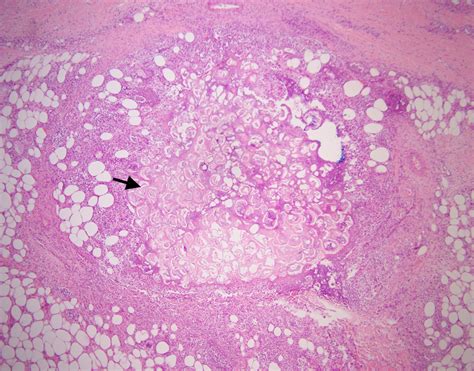 Late Pancreatic Panniculitis In A Simultaneous Pancreas Kidney