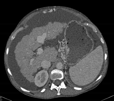 Cirrhosis With Portal Hypertension And Recanalization Of The Umbilical