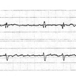 (PDF) Holiday Heart Syndrome