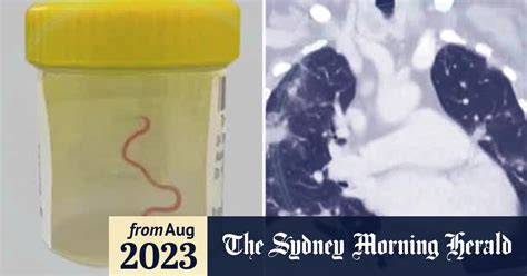 Video Live Worm Found Inside Australian Woman S Brain