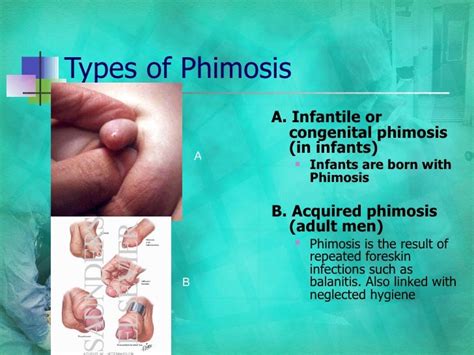 Types Of Phimosis Pictures Circumcision Male Dhsfk