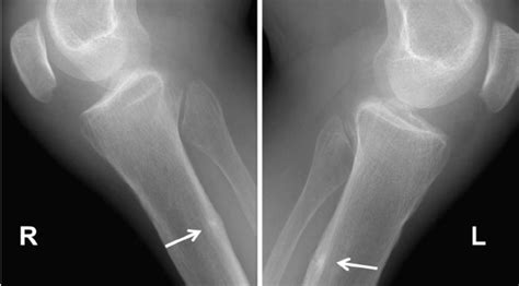 Lateral Radiographs Of Right And Left Tibiae And Fibulae Showing