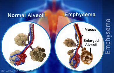 emphysema  symptoms signs diagnosis treatment