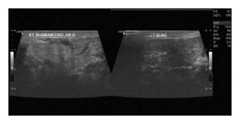 Neck Ultrasound Of Both Submandibular Glands Which Shows Left Download Scientific Diagram