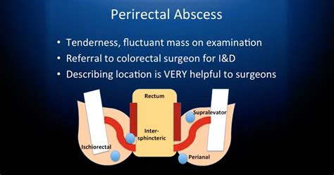 Treatment Options for Anorectal Disorders | Medspira