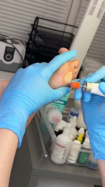 Обработка стоп при медицинском педикюре 🦶🏻Не забудьте ПОДПИСАТЬСЯ 📲 ...