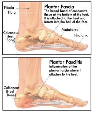 What is Plantar Fasciitis? - Pivotal Physio