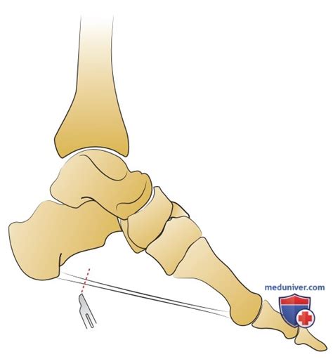 Причины патологически высокого продольного медиального свода стопы ...