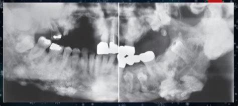 Multifocal Radiopacities Flashcards Quizlet