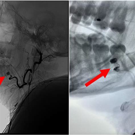 Arteriography Showing Left Facial Artery Pseudoaneurysm Left And