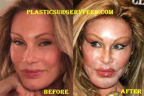 Jocelyn Wildenstein Before Plastic Surgery - Plastic Surgery Feed