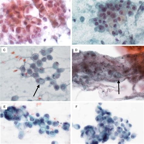 Signet Ring Cells Srcs Of Invasive Ductal Carcinoma Idc A