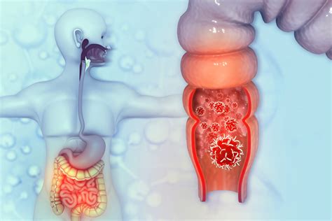 Tumore Al Colon Cause Frequenti E Informazioni Essenziali