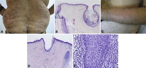 New Insights Into Folliculotropic Mycosis Fungoides Fmf A Single