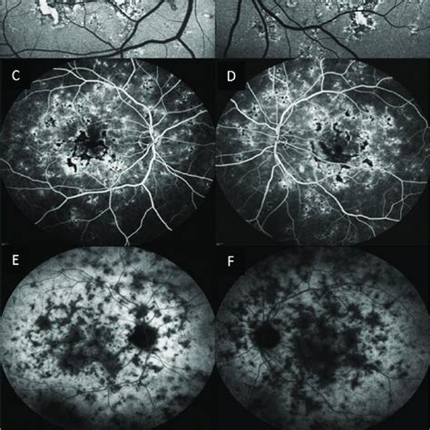 Optical Coherence Tomography Angiography Octa Of Patient No 2 Download Scientific Diagram