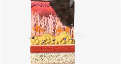 The in Stage III ALM Acral Lentiginous Melanoma Stock Illustration ...