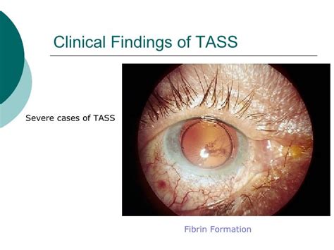 Toxic Anterior Segment Syndrome