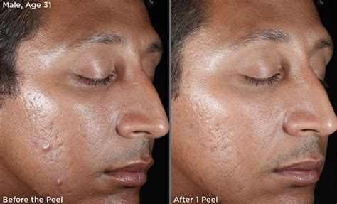 Chemical Peels Peel Away Imperfections Age Spots Acne Scars