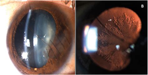 Posterior Subcapsular Cataract