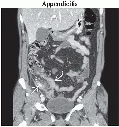 Da Db Acute Right Lower Quadrant Pain Ffu Abdominal Key