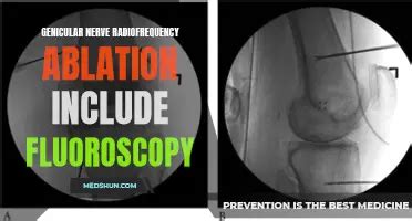 Exploring The Benefits Of Radiofrequency Ablation For Osteoarthritis: A ...