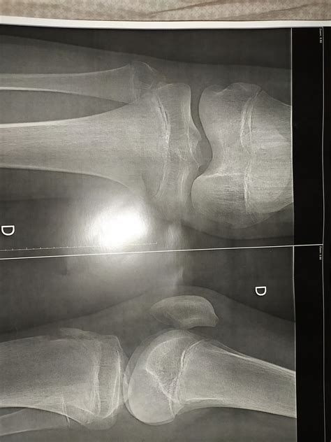 3 Simple Signs To Identify Closed Growth Plates