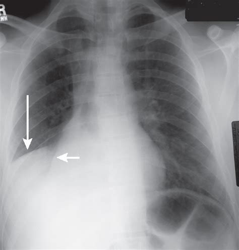 Right Middle Lobe Atelectasis X Ray