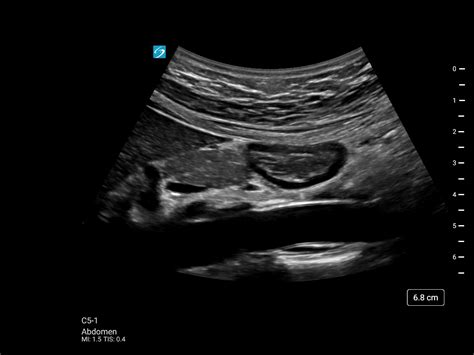 Sonosite St Fujifilm Sonosite