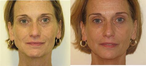 Sculptra Is My Favorite Product It Brings The Most Natural Soft Results Gradually Before And