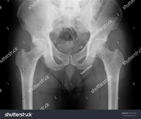 Pelvis Anatomy Xray