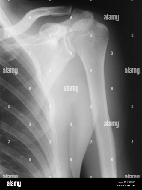 X Ray Image Of Left Shoulder Stock Photo Alamy