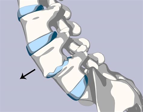 Spondylosis: Definition, Causes, Symptoms, Diagnosis, and Treatment ...