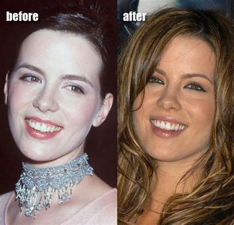 9 Best Plastic Surgery Makeovers Boring Duckling