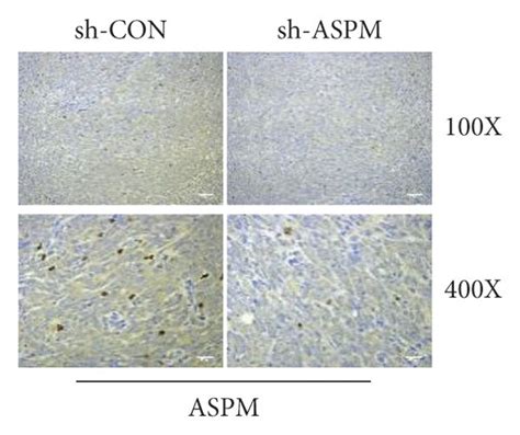 Aspm Promotes Subcutaneous Tumor Growth In Nude Mice A Tumor Volume