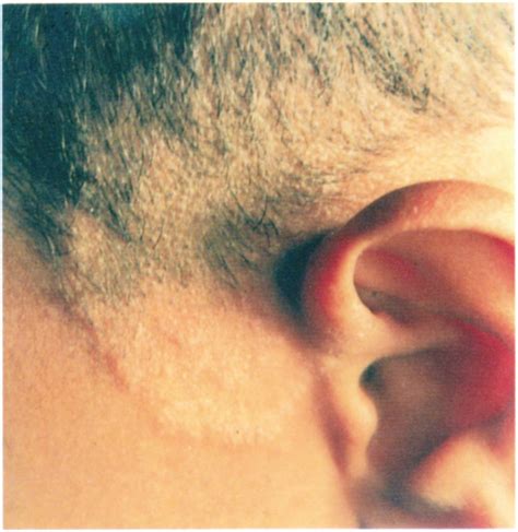 Scalp Fungus Infections In The Eastern ProvinceOf Saudi Arabia Annals