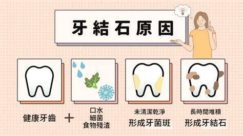 為什麼要牙結石清除？有辦法自行清除牙結石嗎？預防牙結石的3種處理方法