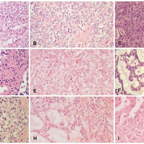 Grading Of Mucoepidermoid Carcinoma A A Low Grade Tumor Demonstrating Download Scientific