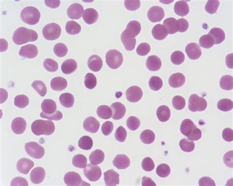 Spherocytosis Spleen