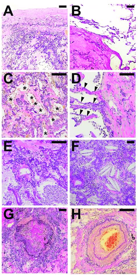 Typical Histological Patterns In Special Association With Alveolar