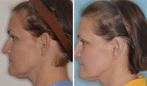 Otoplasty Photos | Miami, FL | Patient 1365